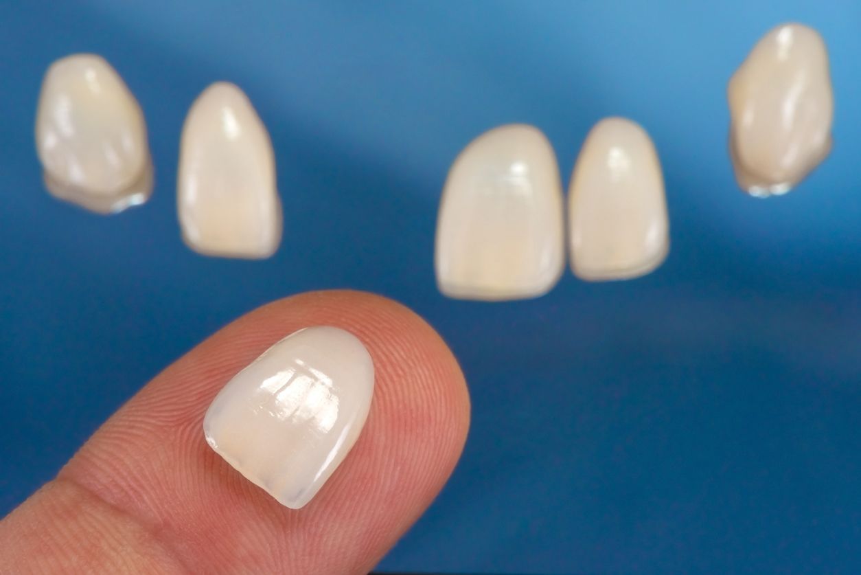 porcelain veneer