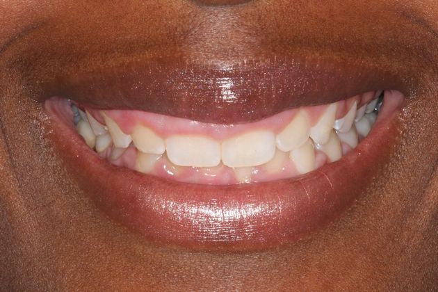 before smile makeover